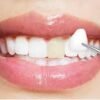 5 Top Reasons To Get Dental Veneers 5 dental vaneer