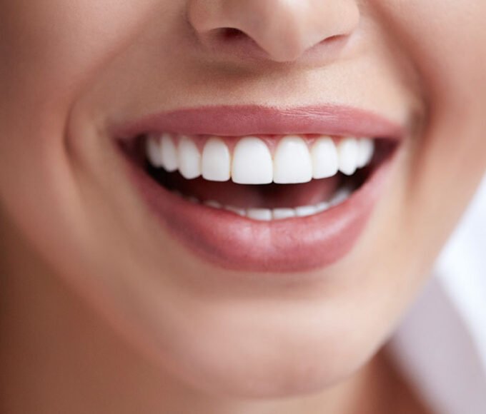 Porcelain Veneers