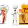 An Overview on Root Canal Procedure and Its Cost  5 root