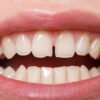 Are Teeth Gap Bands Safe