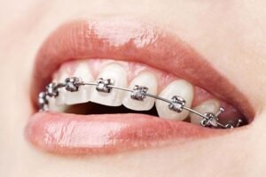 Braces 1