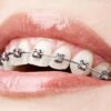 Addressing Braces Myths Dispelling Common Misconceptions 3 Braces